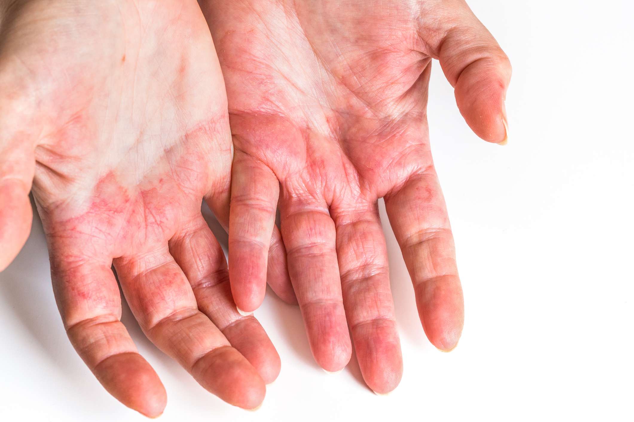 Dermatites: 8 tipos para conhecer 2 Dermatite cronica de mãos: um exemplo comum de dermatite de contato